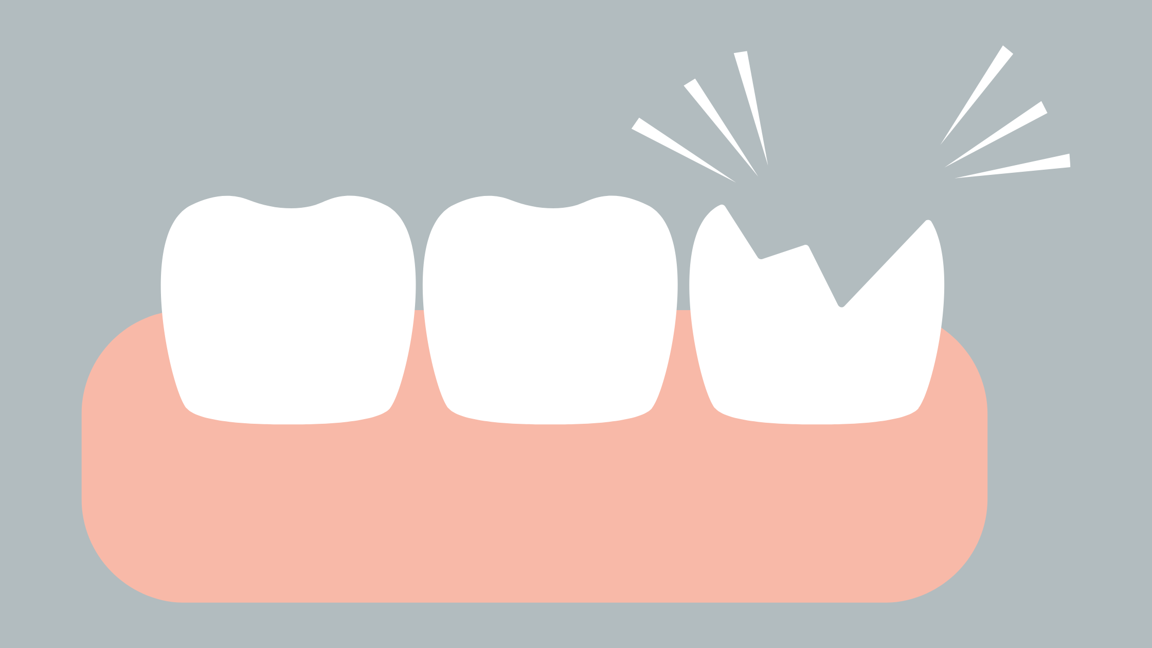 Fractured-Tooth-Dental-Emergency